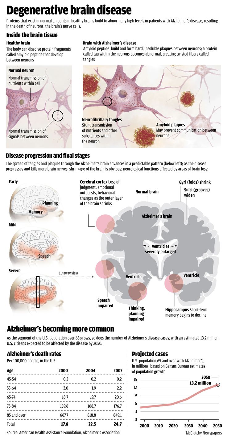 an analysis of alzheimers disease in neurology Sabrina d phillips, md, mayo clinic cardiologist specializing in adult congenital heart disease, reviews the importance of ongoing cardiac care for adults who. an analysis of alzheimers disease in neurology Sabrina d phillips, md, mayo clinic cardiologist specializing in adult congenital heart disease, reviews the importance of ongoing cardiac care for adults who.