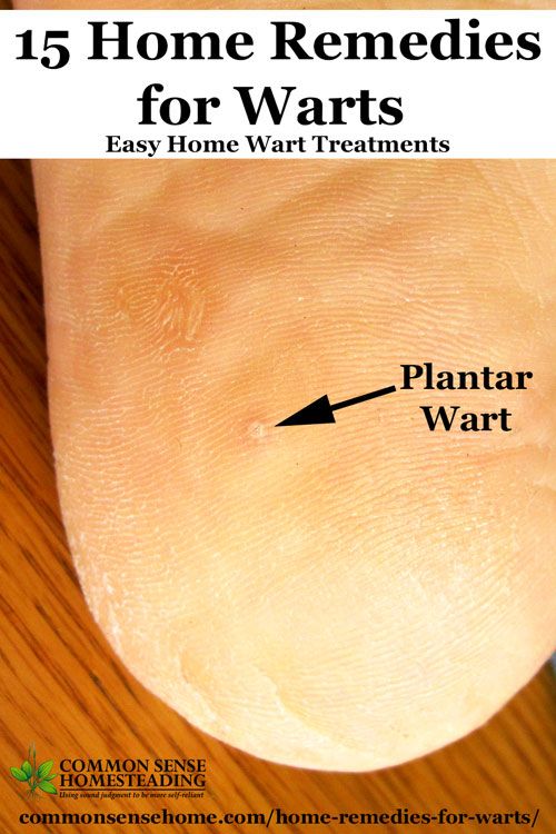 WANNA FUCK cure facial warts