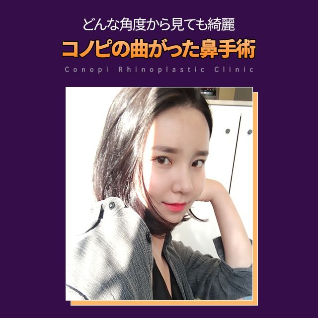 韓国鼻専門 コノピ美容整形外科 曲がった鼻整形 美容整形 美容整形外科 整形手術 韓国鼻専門 コノピ美容整形外科 曲がった鼻整形 美容整形 美容整形外科 整形手術