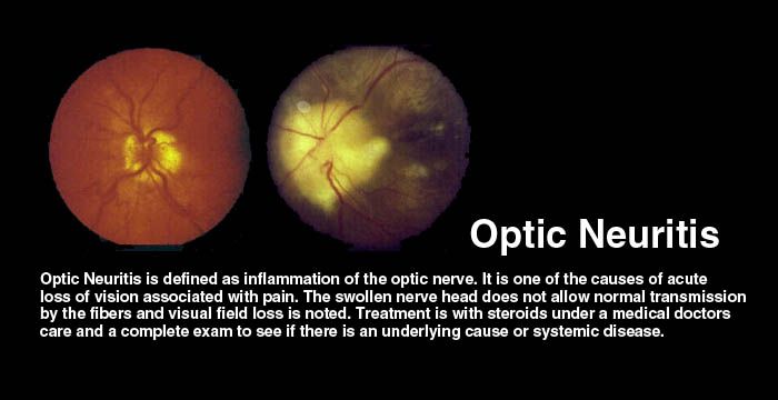 Optic Neuritis Natural Cure Optic Neuritis Natural Cure