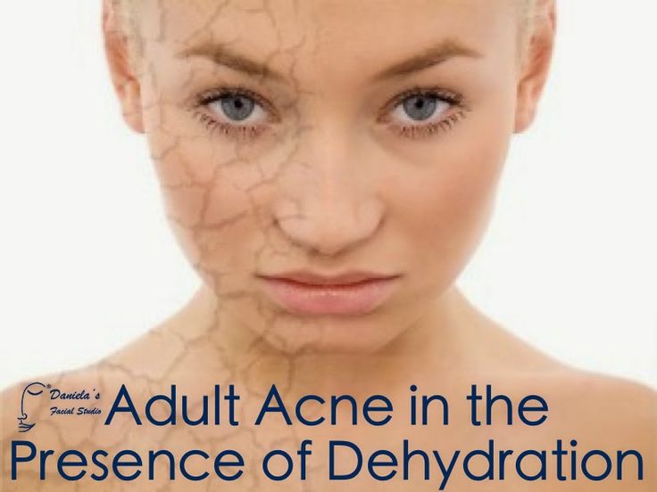 acne adult blackheads acne adult blackheads