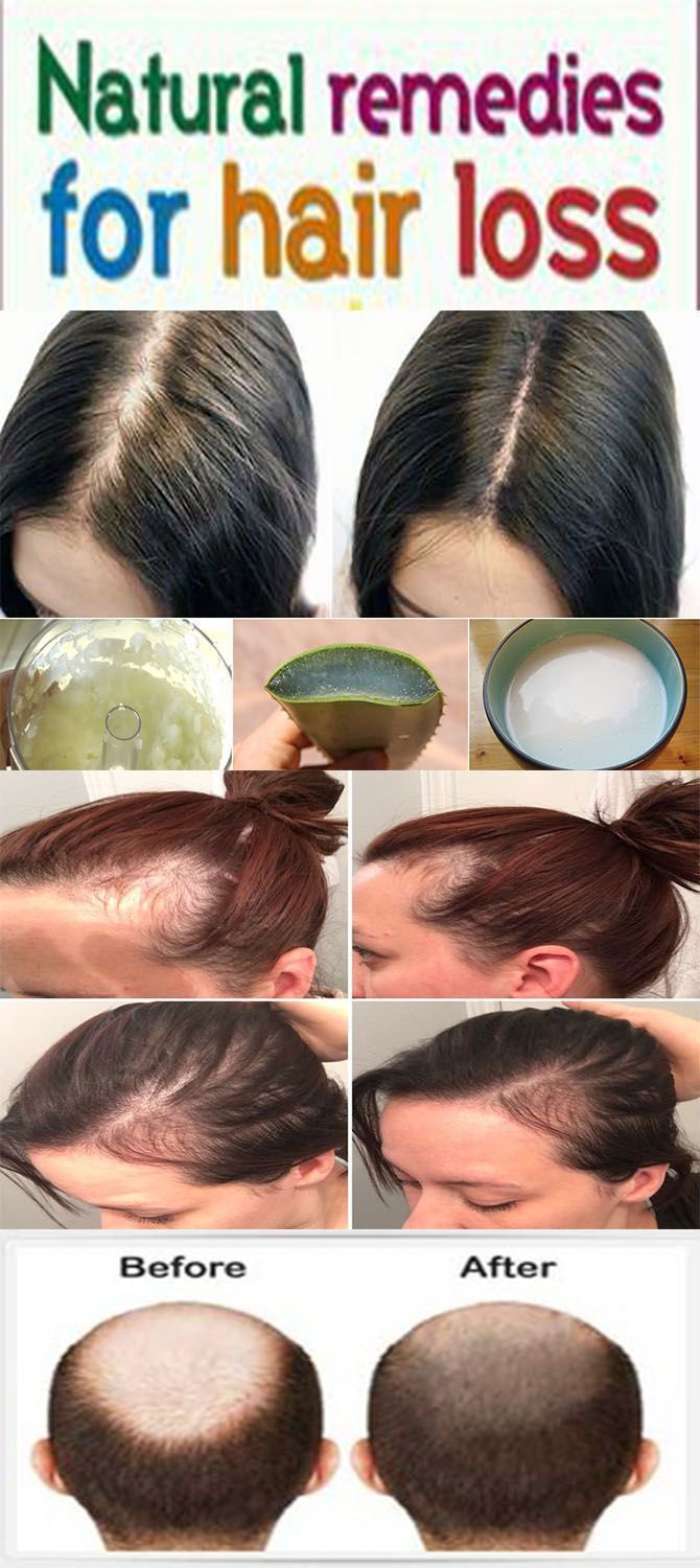 How To Control Hair Fall Stop Hair Fall Home Remedies For Hair Loss Hairlosshomeremedies Hairlossn Hair Loss Remedies Home Remedies For Hair Hair Control