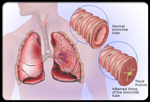 5 remedies that remove phlegm & mucus fast (With images) Chest congestion remedi