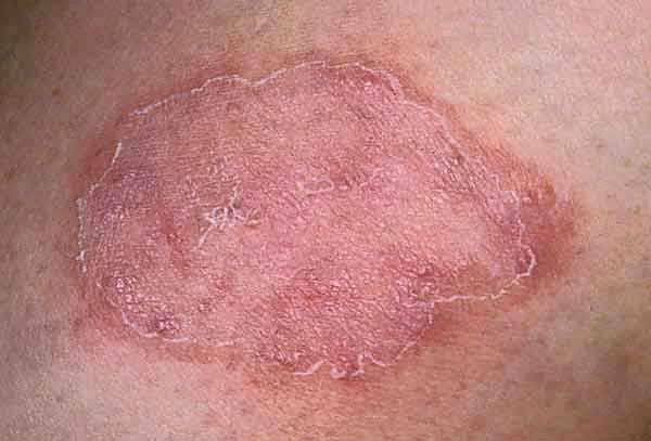 Is There A Natural Way To Treat Lyme Disease Is There A Natural Way To Treat Lyme Disease