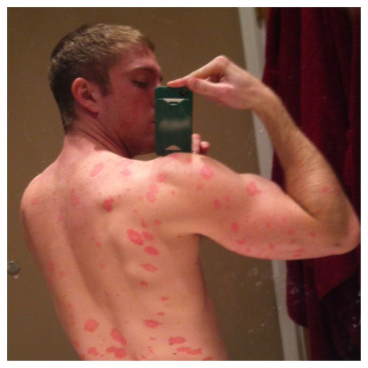 How To Get Rid Of Guttate Psoriasis Naturally How To Get Rid Of Guttate Psoriasis Naturally