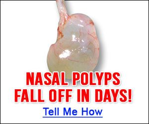 Nasal Polyps Natural Treatment Tea Tree Oil Nasal Polyps Natural Treatment Tea Tree Oil
