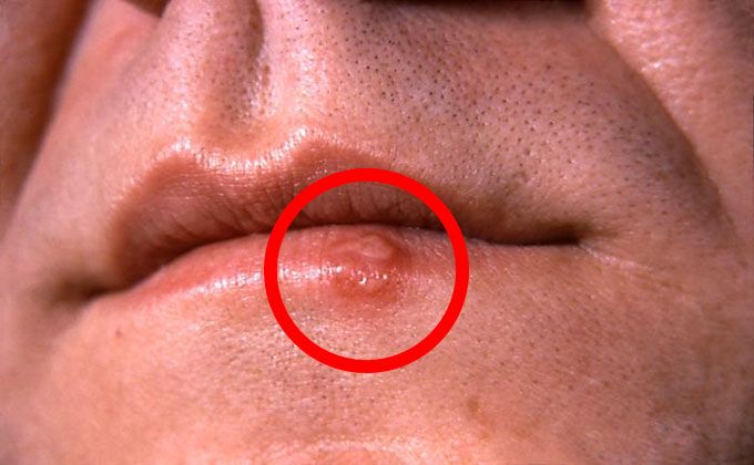 Cold Sore Lip Remedy Natural Cold Sore Lip Remedy Natural