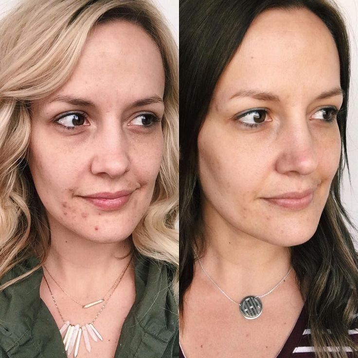 617 best rodan fields images on pinterest skin treatments tried everything for acne nothing works