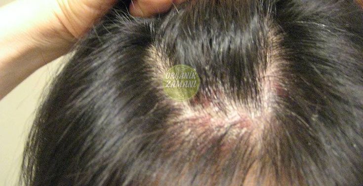 Jan 21, 2020 - Miracle That Passes Eczema In The Hair! - # eczema # Eczema That Passes #Ezema #Mi ...#eczema #ezema #hair #miracle #passes