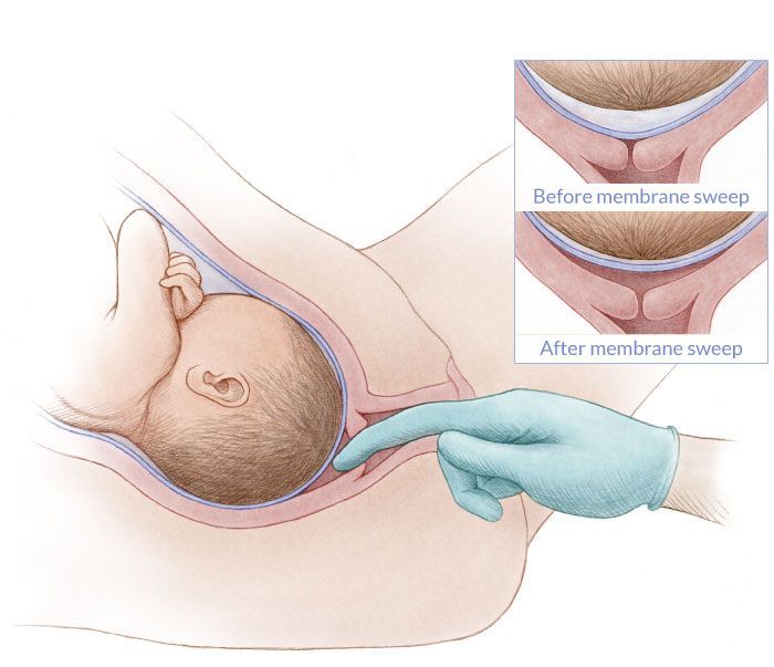 pregnancy membrane sweep diagram 173 best illustrations images on birth pregnancy membrane sweep diagram 173 best illustrations images on birth