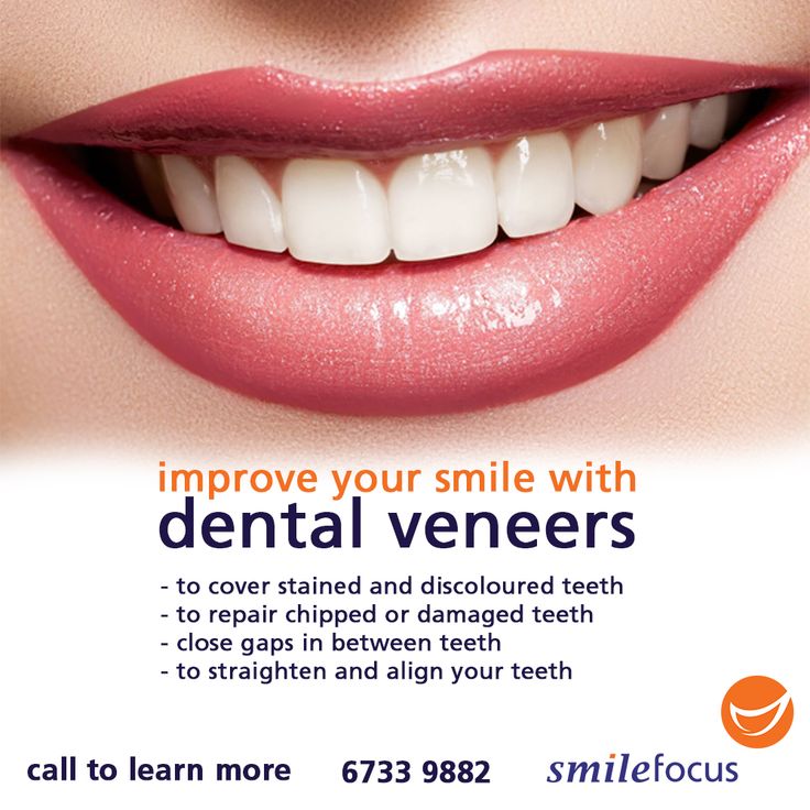Dental Insurance That Will Cover Veneers