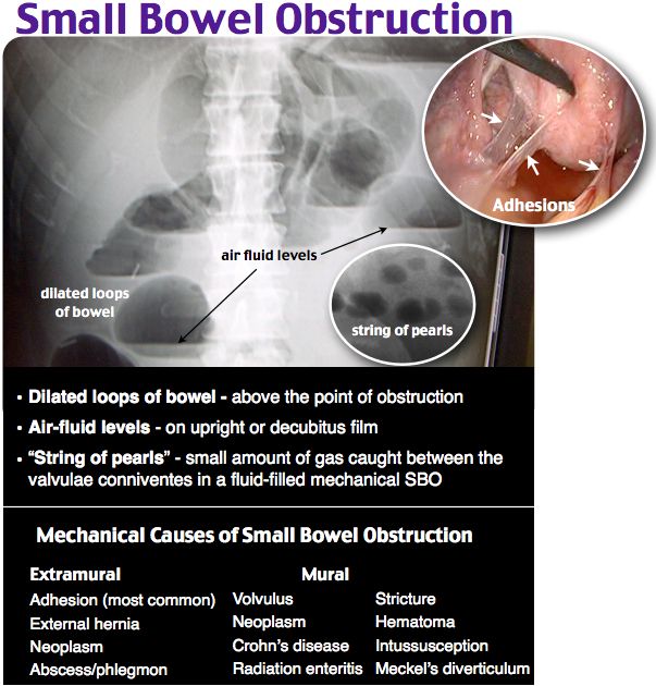 Rosh Review | Small bowel obstruction, Bowel obstruction, Medical mnemonics