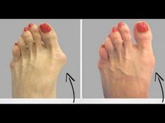 La Forma Más Facil Y Sencilla De Eliminar Los Juanetes De Forma Natural Y Sin Sufrir Dolor Youtube Remedios Para Juanetes Juanetes Como Curar Los Juanetes