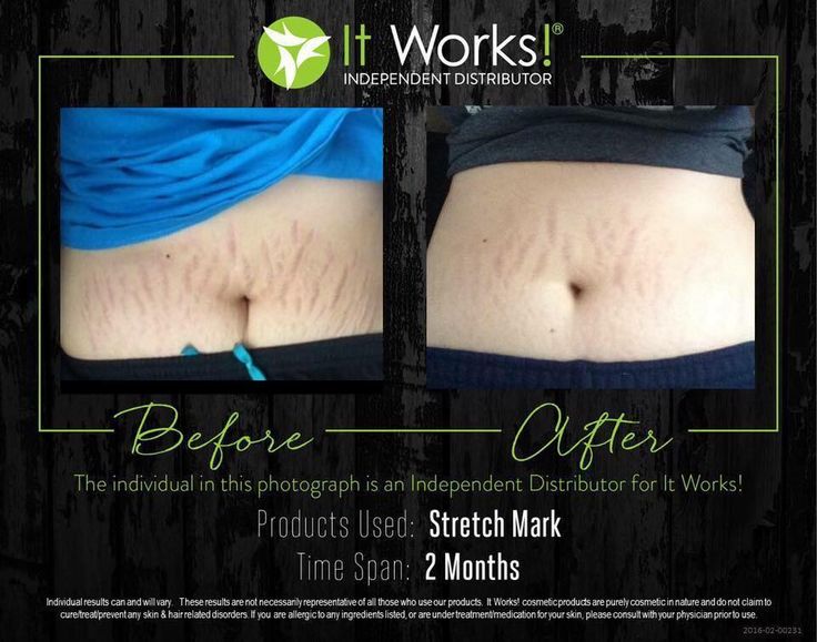10 best it works stretch mark cream images on pinterest stretch stretch works