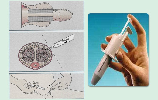 Viagra after prostate removal