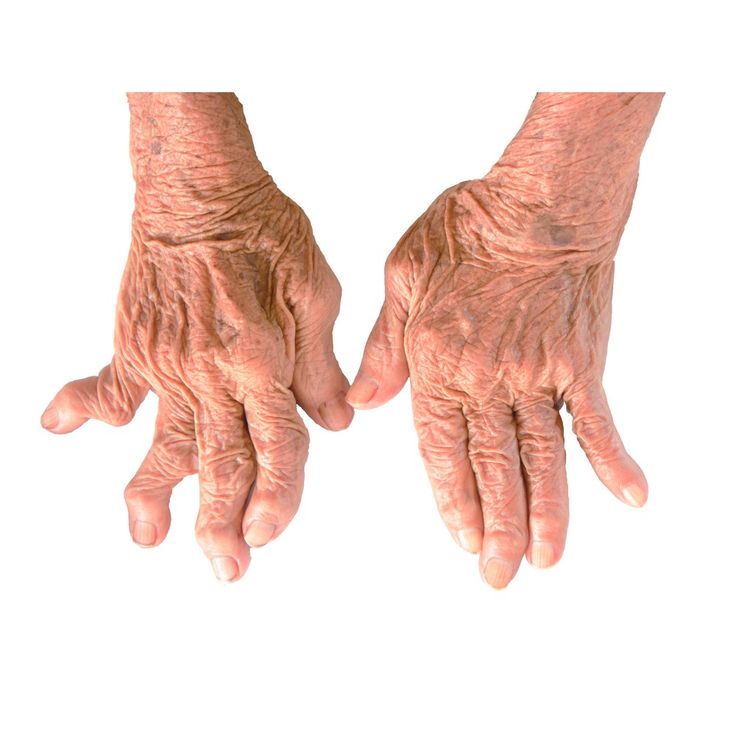 iguratimodt 614 rheumatoid arthritis forecast and And osteoclastogenesis by iguratimod (igu, t-614), a disease-modifying anti-rheu- matic drug, using adjuvant-induced arthritis (aia) rats and receptor activator of. iguratimodt 614 rheumatoid arthritis forecast and And osteoclastogenesis by iguratimod (igu, t-614), a disease-modifying anti-rheu- matic drug, using adjuvant-induced arthritis (aia) rats and receptor activator of.
