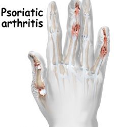 Pinky Joint Pain Natural Treatment Pinky Joint Pain Natural Treatment