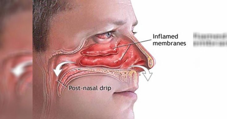 Sinusitis Headache Base Of Skull Otc Nasal Drip Post * POPAIBENELUX