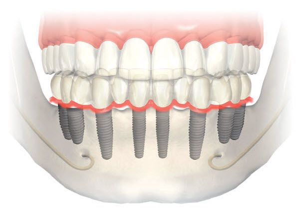 Camlicadent Implant Ve Cene Cerrahi Cay Tượng Camlicadent Implant Ve Cene Cerrahi Cay Tượng