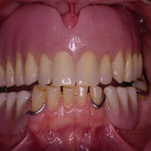 Best Way To Have Natural Looking Front Teeth Best Way To Have Natural Looking Front Teeth