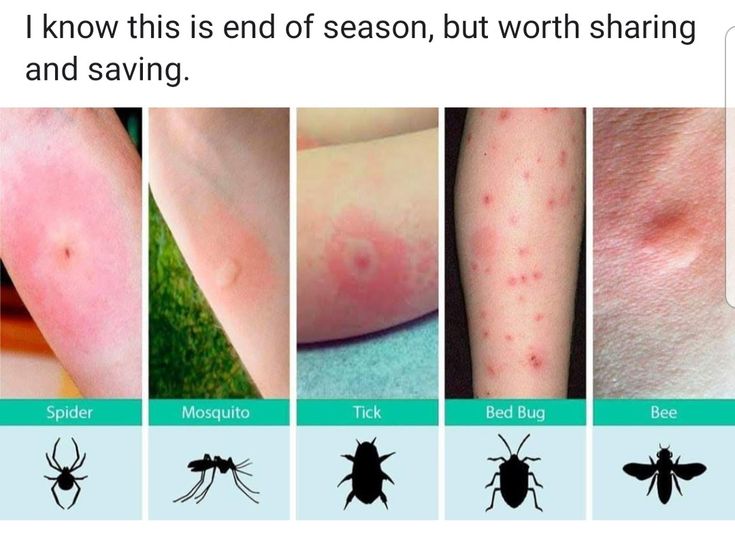 Pin by Heather Saunders on camping Identifying bug bites, Bug bites