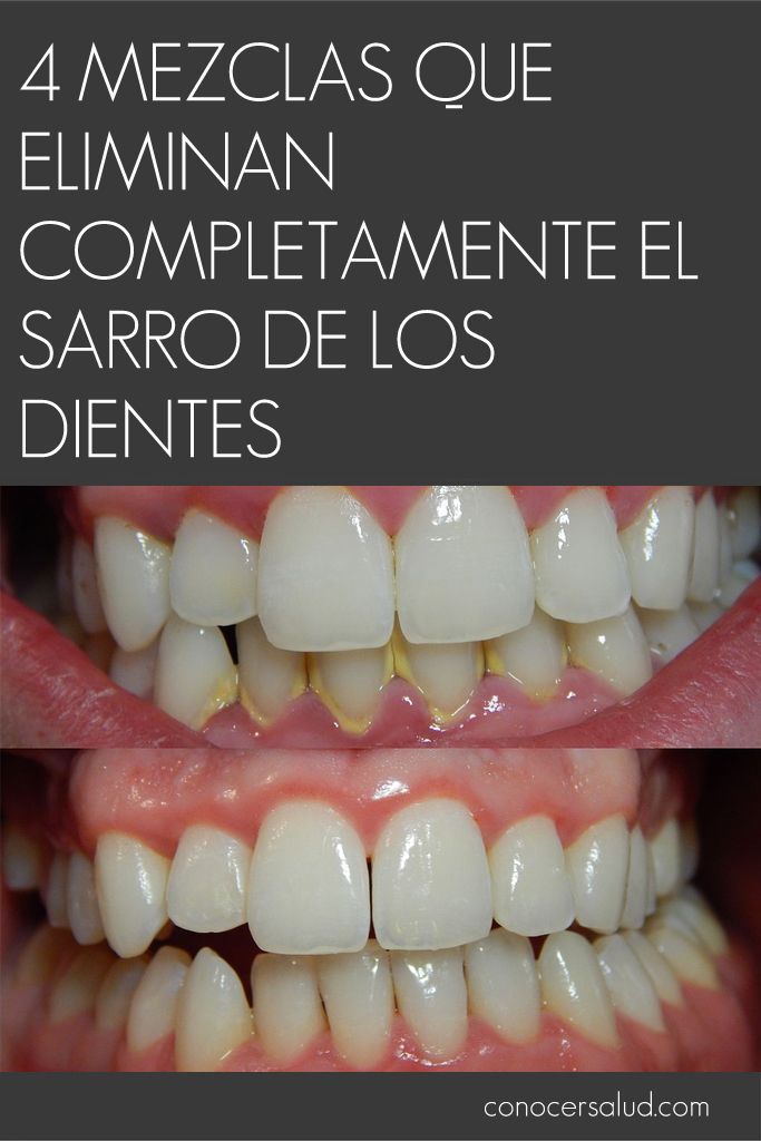 En Apenas 3 Minutos Esta Mezcla Promete Eliminar La Placa Dental Y Sarro Encías Retraídas Eliminar Sarro Dientes Cuidado De Los Dientes
