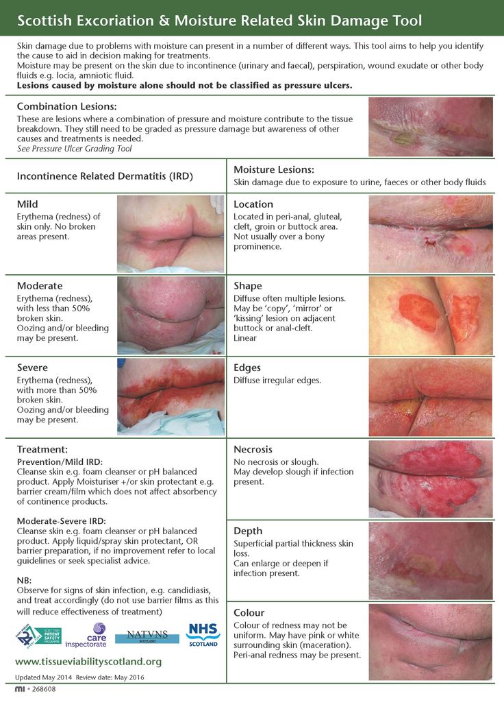 or Anal and cleft fold or Anal and cleft fold
