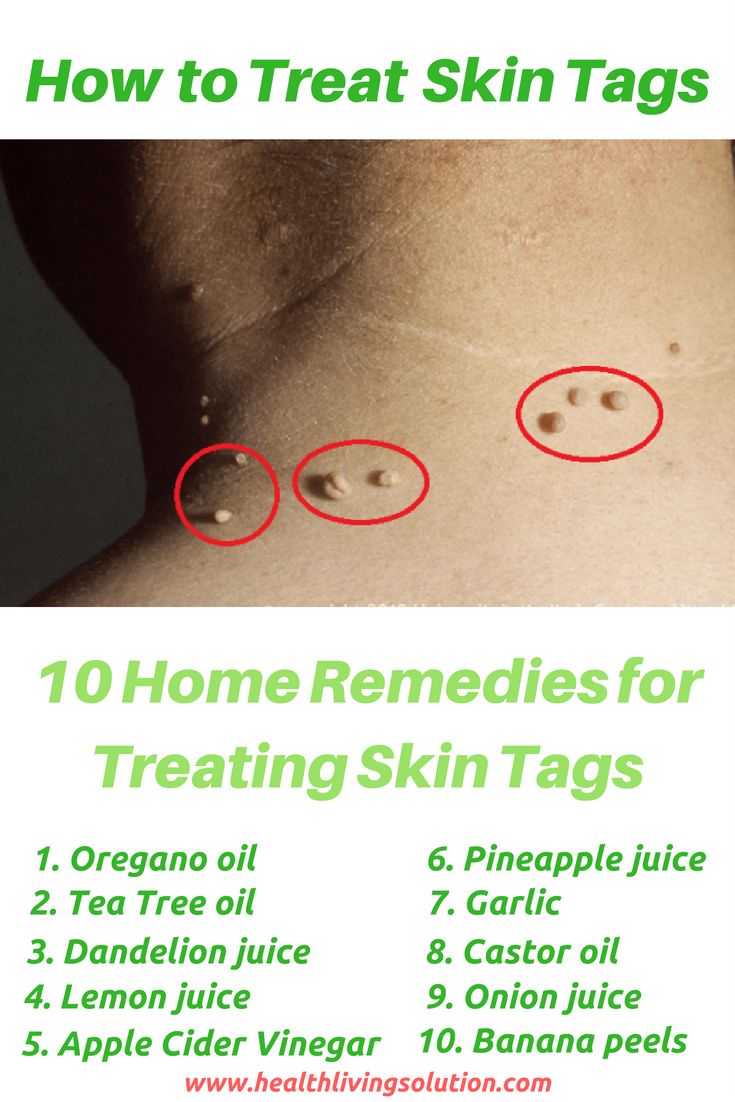 How To Treat Skin Tags Naturally How To Treat Skin Tags Naturally