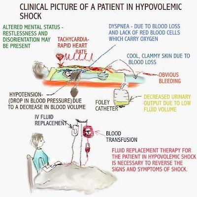 Nursing case study hypovolemic shock
