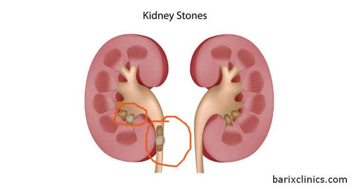 Kidney Stones Remedies From Health Food Stores Kidney Stones Remedies From Health Food Stores