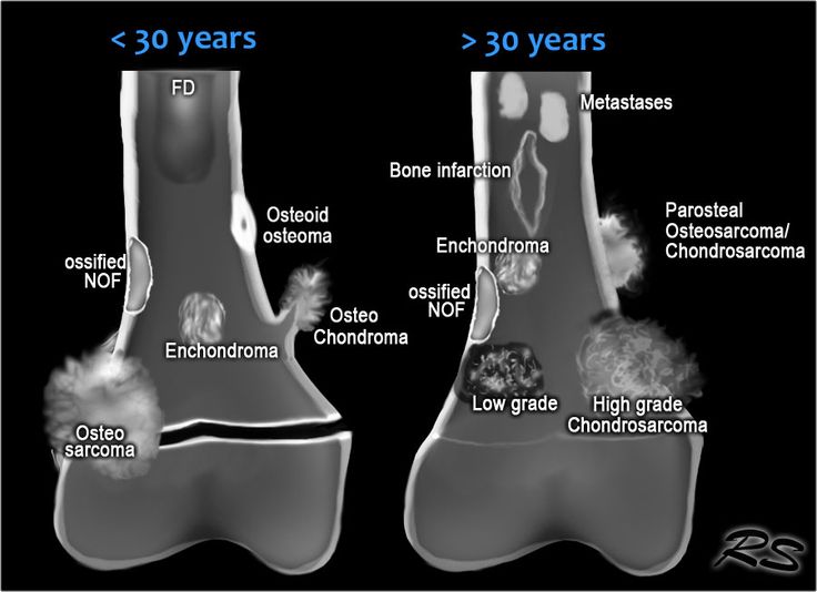 osteosclerotic bone tumors Radiology student, Radiology imaging