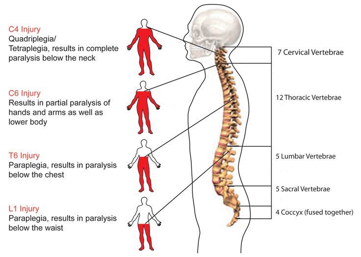 spinal cord injury diagram 99 best spinal cord injury images on spinal spinal cord injury diagram 99 best spinal cord injury images on spinal