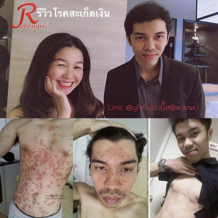 โรคสะเก ดเง น น าร ก