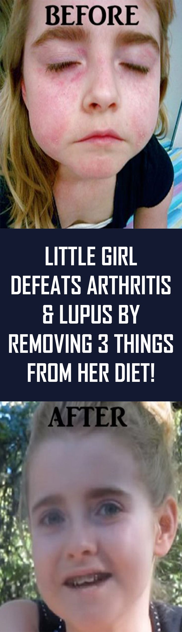 Little Girl Defeats Arthritis & Lupus By Removing 3 Things From Her Diet!
