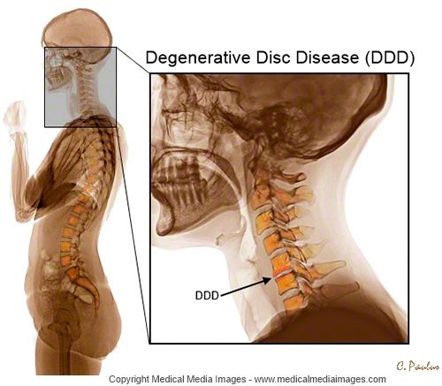 Natural Cures For Disc Disease Natural Cures For Disc Disease