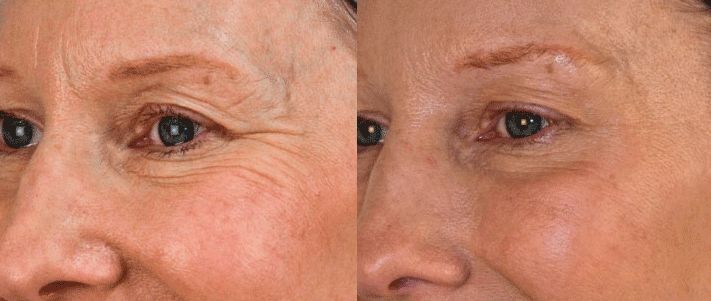 Natural Way To Get Rid Of Wrinkles Between Eyebrows Natural Way To Get Rid Of Wrinkles Between Eyebrows