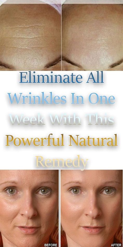 Jan 8, 2019 - You may want to find out more about wrinkles. Why is it important to learn about aging and its effects on you? Unless you are not concerned with your health or well being later in life, learning about how to deal with aging is essential. If you wish to live a long and happy life...