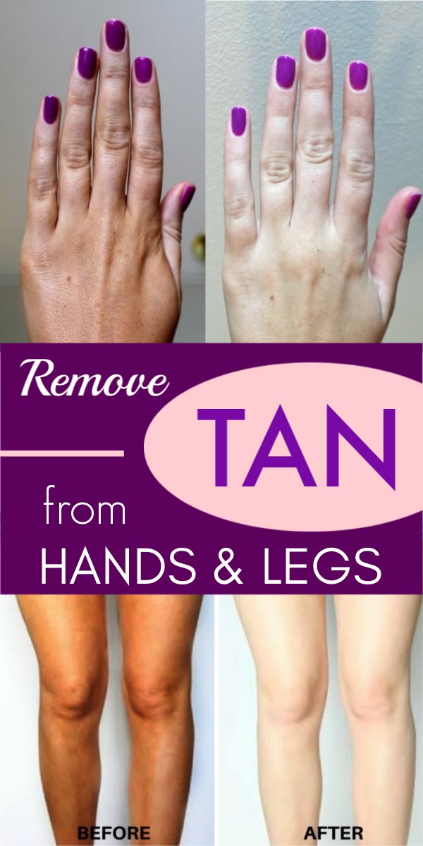 How To Remove Tanning From Hands And Feet Instantly – 100% Effective #skinwhit...