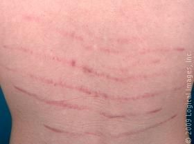 deep stretch marks deep stretch marks