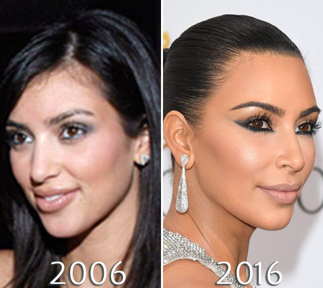 Kim Kardashian nose before and after photo Kim Kardashian Before and