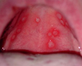 122 best http://www.healthncare.org/ images on Pinterest | Remedies, Hormonal changes and Cure