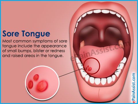 Pimples on tongue