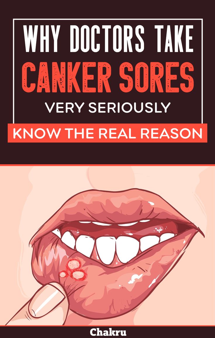 Canker sores causes and remedies you must know Canker