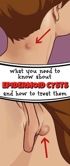 Can You Get Rid Of Skin Tags Naturally Can You Get Rid Of Skin Tags Naturally