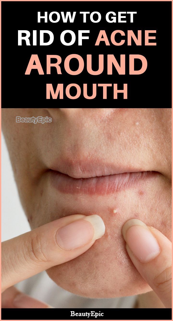 How To Get Rid Of Acne Around Mouth PoppingPimples Chin Acne Chin How To Get Rid Of Acne Around Mouth PoppingPimples Chin Acne Chin