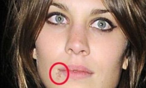 cold sore dating site Hdatecom - the best, largest and completely anonymous online h dating site for people with herpes, hpv and hiv meet and chat with h singles. cold sore dating site Hdatecom - the best, largest and completely anonymous online h dating site for people with herpes, hpv and hiv meet and chat with h singles.