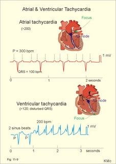 Wanna atrial tachycardia rhythm strip perfect, this the