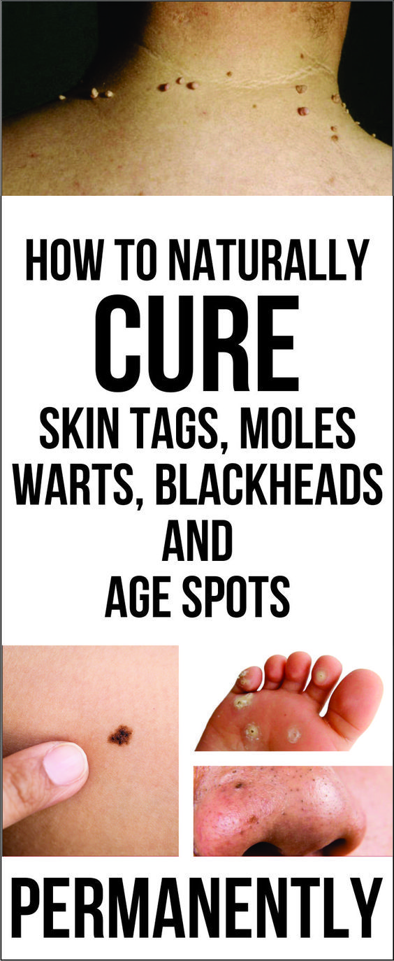 How To Cure Warts On Face Naturally How To Cure Warts On Face Naturally