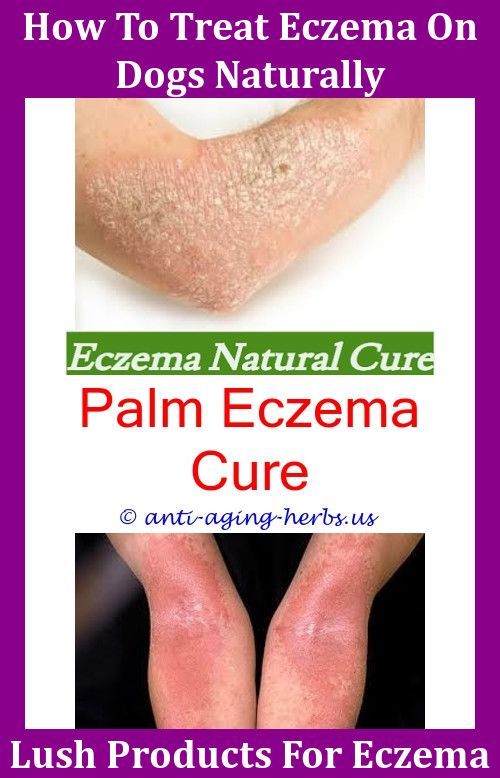 Can #Eczema #Be #Treated #Liver #And #Eczema #Can #Shaving #Cause #Eczema #Eczema #Cuticles #Silk #Gloves #For #Eczema,skin #allergy #eczema #what #to #do #for #eczema #porridge #oats #for #eczema #best #hair #dye #for #eczema #eczema #lotion #walmart.Cause #Eczema #Eczema #Severe #Itching,most #common #places #for #eczema #african #potato #cream #eczema #- #eczema #and #psoriasis #best #moisturizer #for #toddler #eczema.