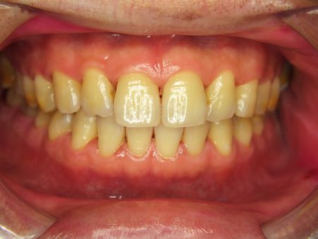 Cavity Filling